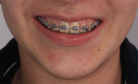 beneficios de los brackets metalicos|ortodoncia de brackets metalicos.